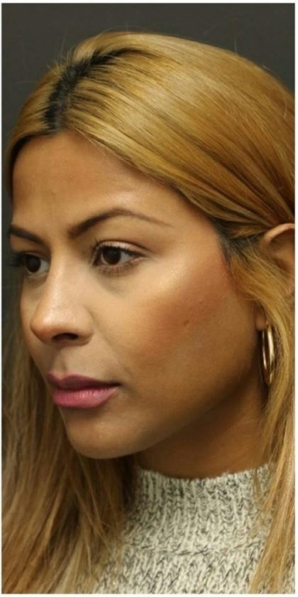 Rhinoplasty Before & After Patient #1217