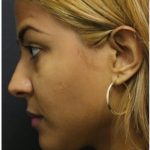 Rhinoplasty Before & After Patient #1217