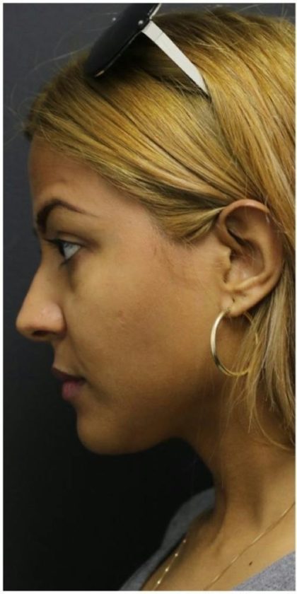 Rhinoplasty Before & After Patient #1217