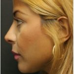 Rhinoplasty Before & After Patient #1217