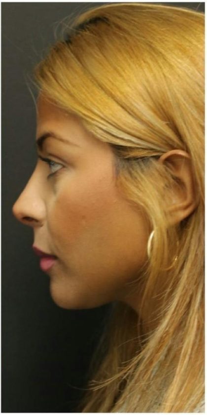 Rhinoplasty Before & After Patient #1217