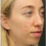 Rhinoplasty Before & After Patient #1216