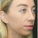 Rhinoplasty Before & After Patient #1216