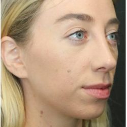 Rhinoplasty Before & After Patient #1216