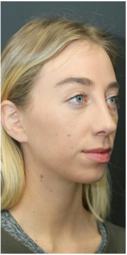 Rhinoplasty Before & After Patient #1216