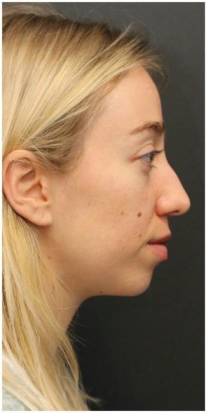 Rhinoplasty Before & After Patient #1216