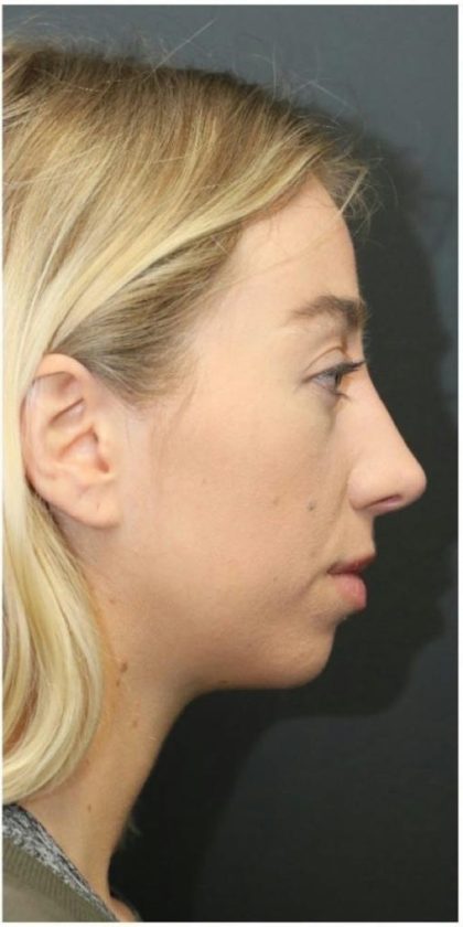 Rhinoplasty Before & After Patient #1216