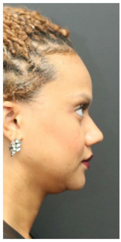 Rhinoplasty Before & After Patient #1215