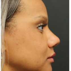 Rhinoplasty Before & After Patient #1215