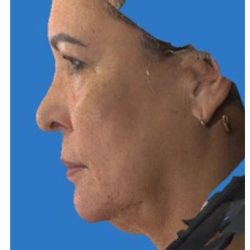 Rhinoplasty Before & After Patient #1214