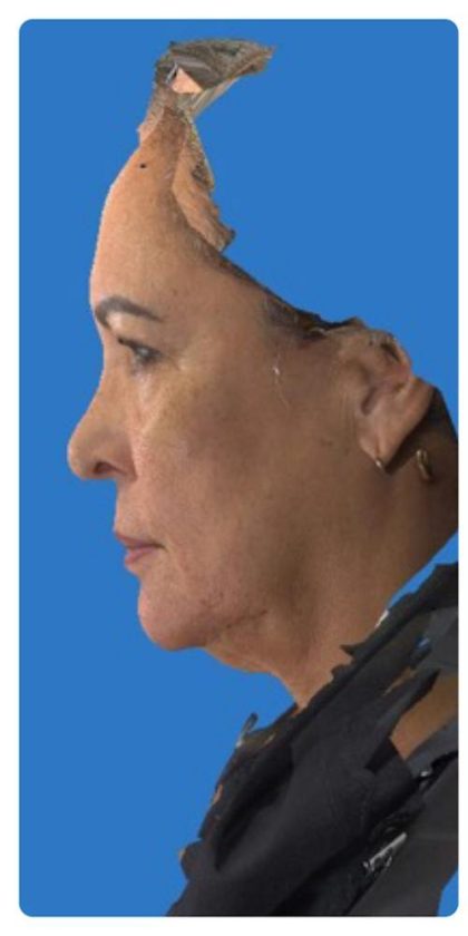 Rhinoplasty Before & After Patient #1214