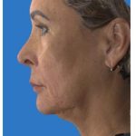 Rhinoplasty Before & After Patient #1214