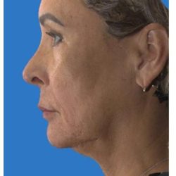 Rhinoplasty Before & After Patient #1214