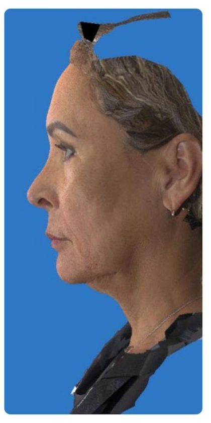Rhinoplasty Before & After Patient #1214