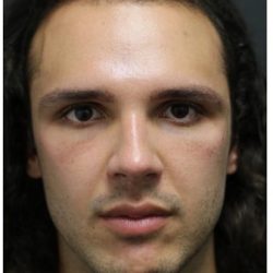 Rhinoplasty Before & After Patient #1213