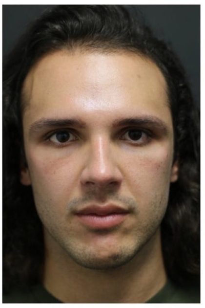 Rhinoplasty Before & After Patient #1213