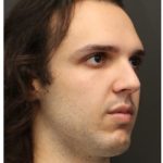 Rhinoplasty Before & After Patient #1213