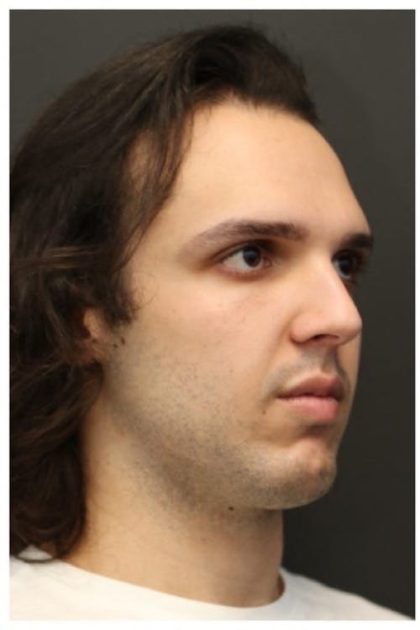 Rhinoplasty Before & After Patient #1213