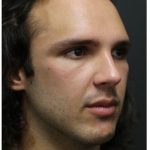 Rhinoplasty Before & After Patient #1213