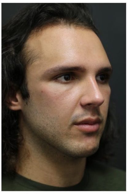 Rhinoplasty Before & After Patient #1213