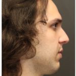 Rhinoplasty Before & After Patient #1213