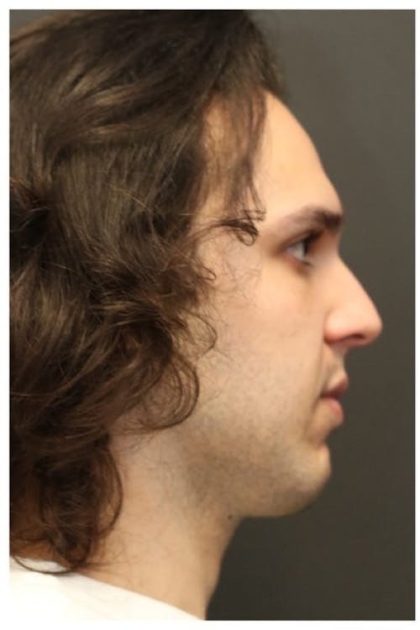 Rhinoplasty Before & After Patient #1213
