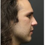 Rhinoplasty Before & After Patient #1213