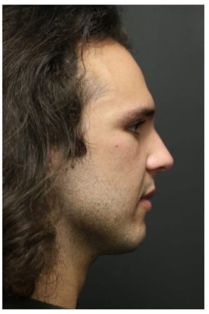Rhinoplasty Before & After Patient #1213