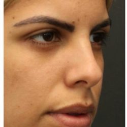 Rhinoplasty Before & After Patient #1212