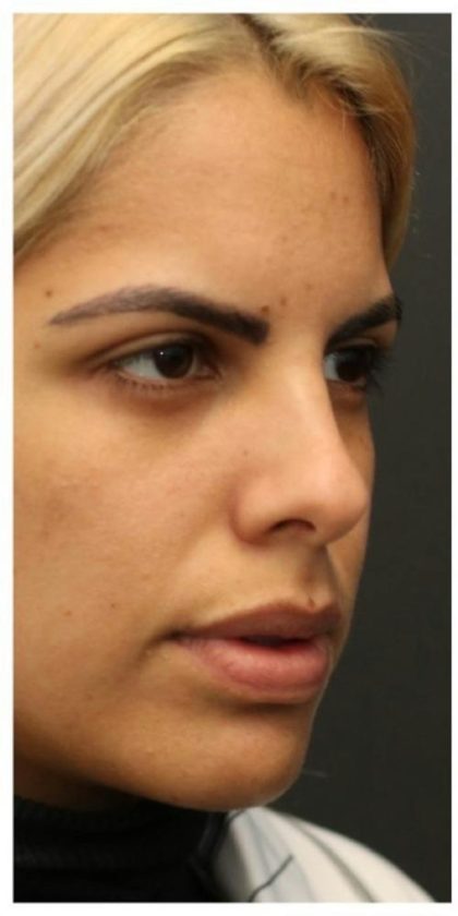 Rhinoplasty Before & After Patient #1212