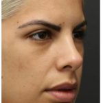 Rhinoplasty Before & After Patient #1212