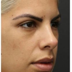Rhinoplasty Before & After Patient #1212