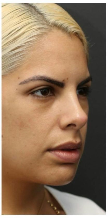 Rhinoplasty Before & After Patient #1212