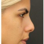 Rhinoplasty Before & After Patient #1212