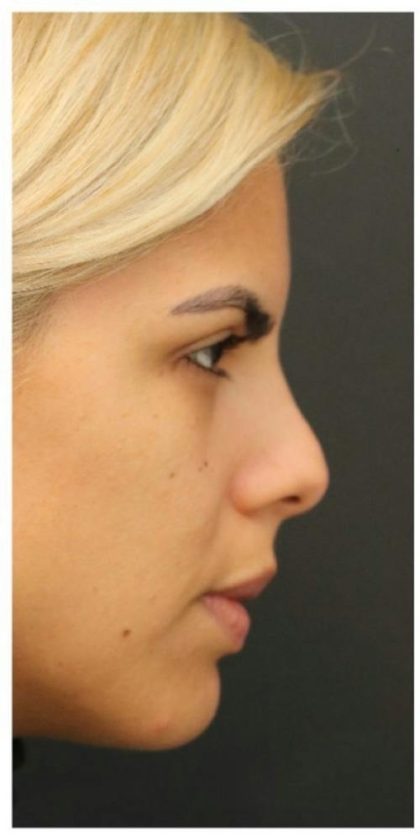 Rhinoplasty Before & After Patient #1212