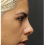 Rhinoplasty Before & After Patient #1212