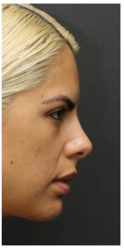 Rhinoplasty Before & After Patient #1212