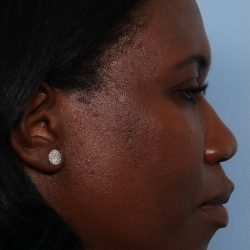 Rhinoplasty Before & After Patient #1224