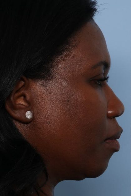 Rhinoplasty Before & After Patient #1224