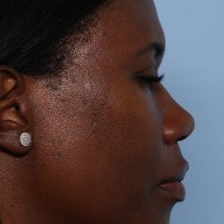 Rhinoplasty Before & After Patient #1224