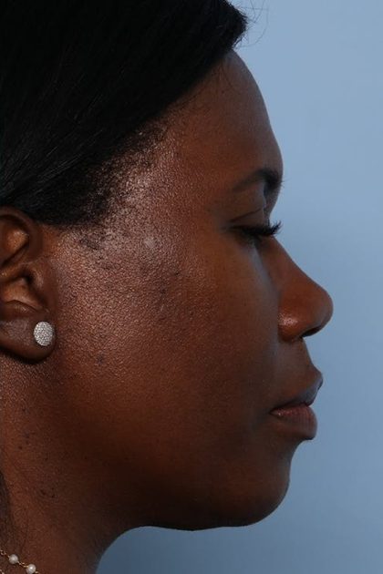 Rhinoplasty Before & After Patient #1224