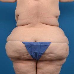 Thigh Lift Before & After Patient #1320