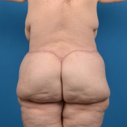 Thigh Lift Before & After Patient #1320