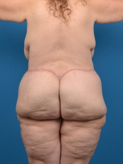 Thigh Lift Before & After Patient #1320