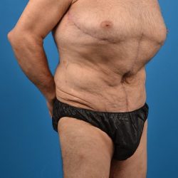 Thigh Lift Before & After Patient #1318