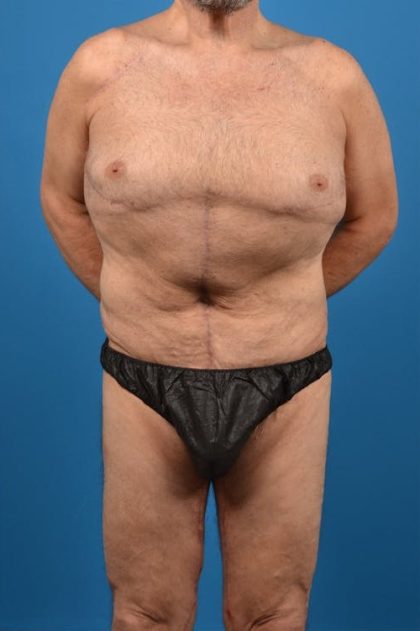 Thigh Lift Before & After Patient #1318