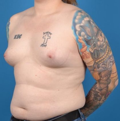 Transgender Surgery (MTF) Before & After Patient #1268