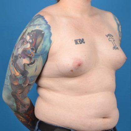 Transgender Surgery (MTF) Before & After Patient #1268