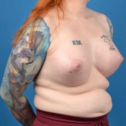 Transgender Surgery (MTF) Before & After Patient #1268