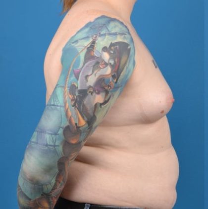 Transgender Surgery (MTF) Before & After Patient #1268